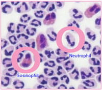 Eosinophils & neutrophils in white blood cells